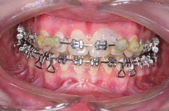 Ортодонтическая подготовка перед проведением операций
