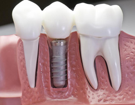 Имплантация при отсутствии одного зуба